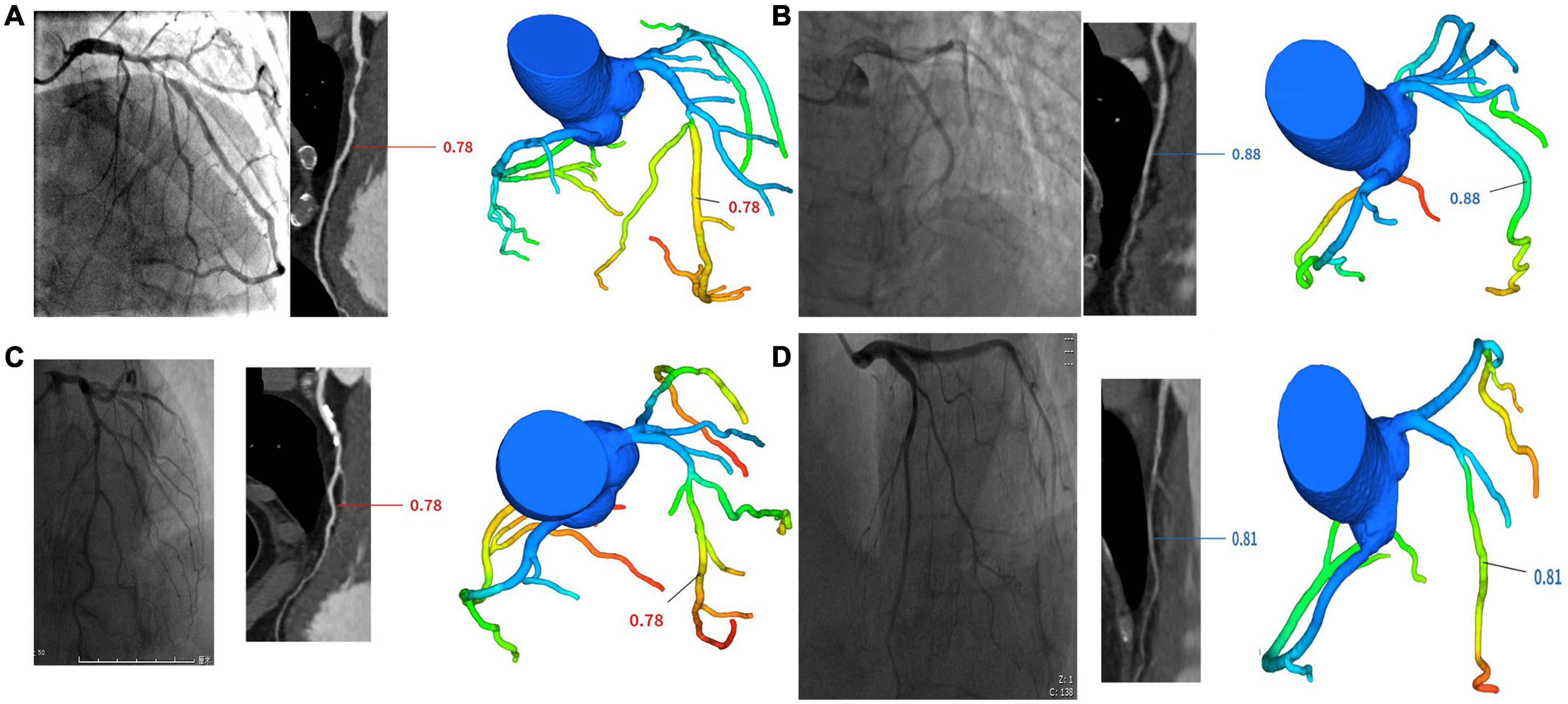 Impact of coronary computed tomography angiography-derived fractional flow reserve based on deep learning on clinical management